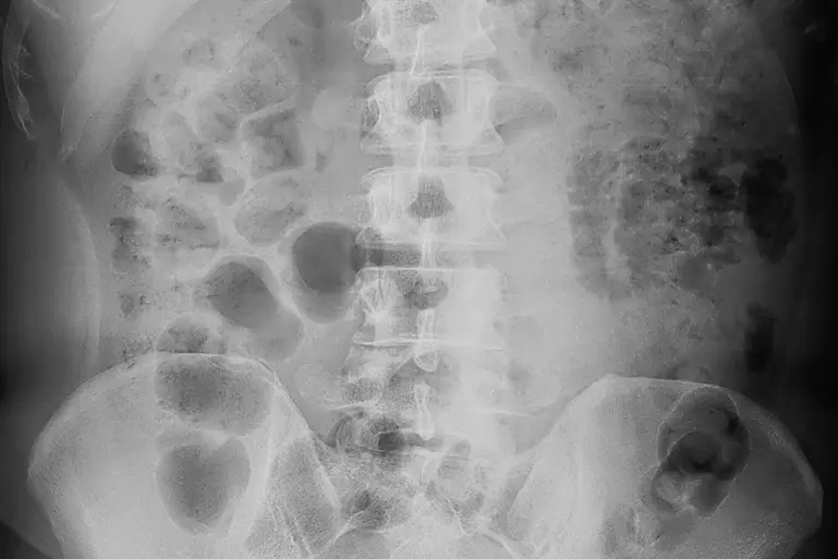 Abdominal X-ray