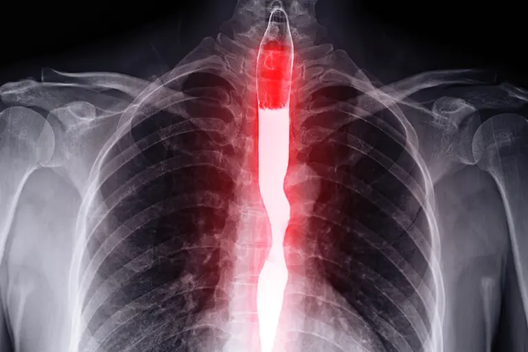 Barium swallow