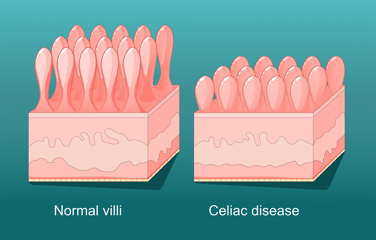 Coeliac disease diagram