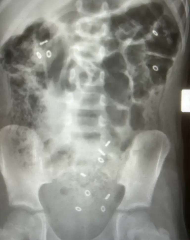 Colonic transit study xray