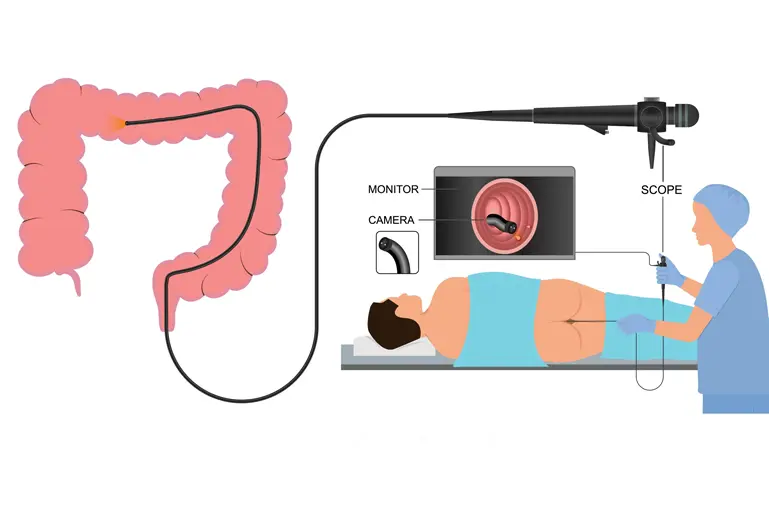 Colonoscopy