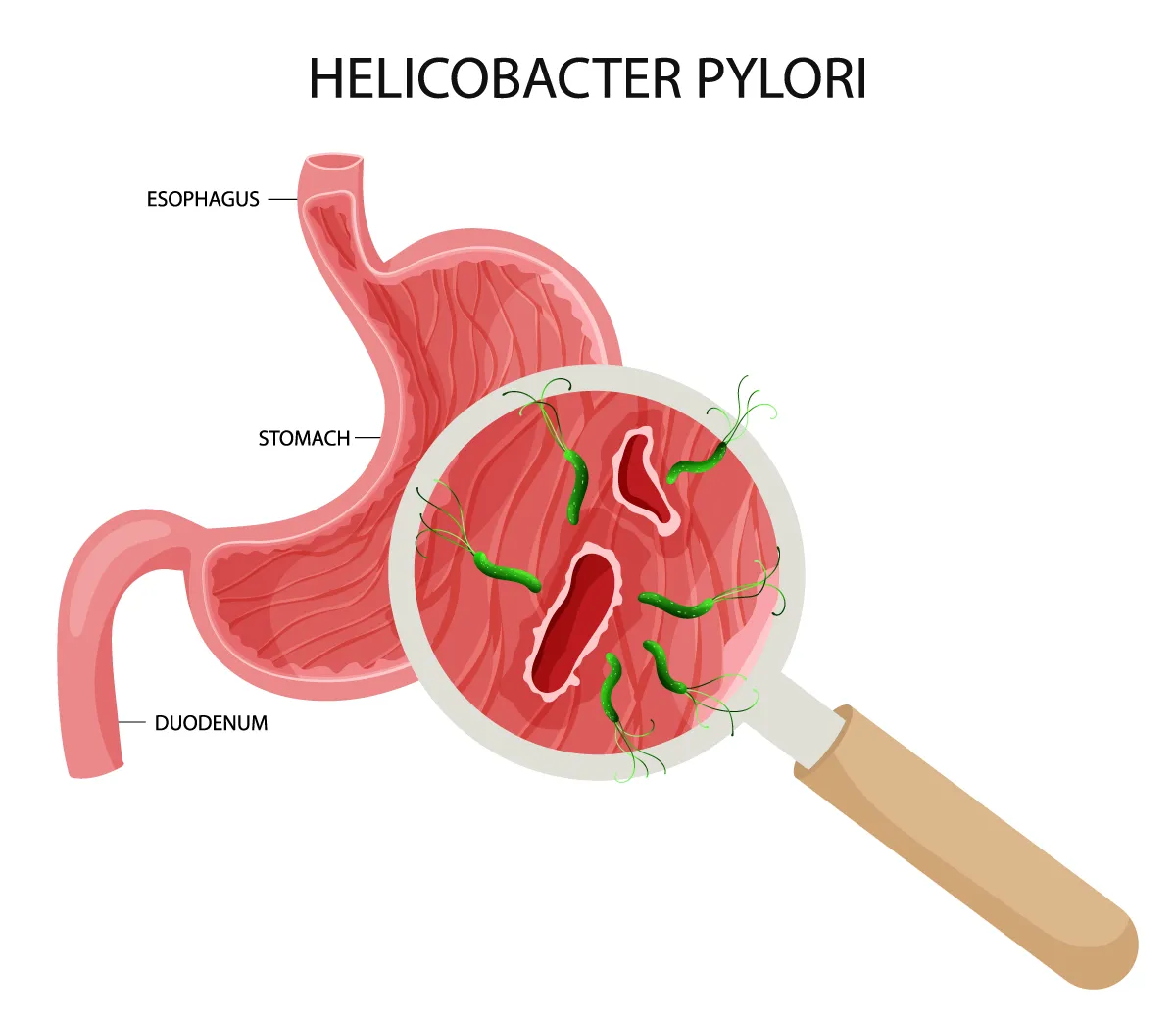 Helicobacter Pylori Gastritis diagram