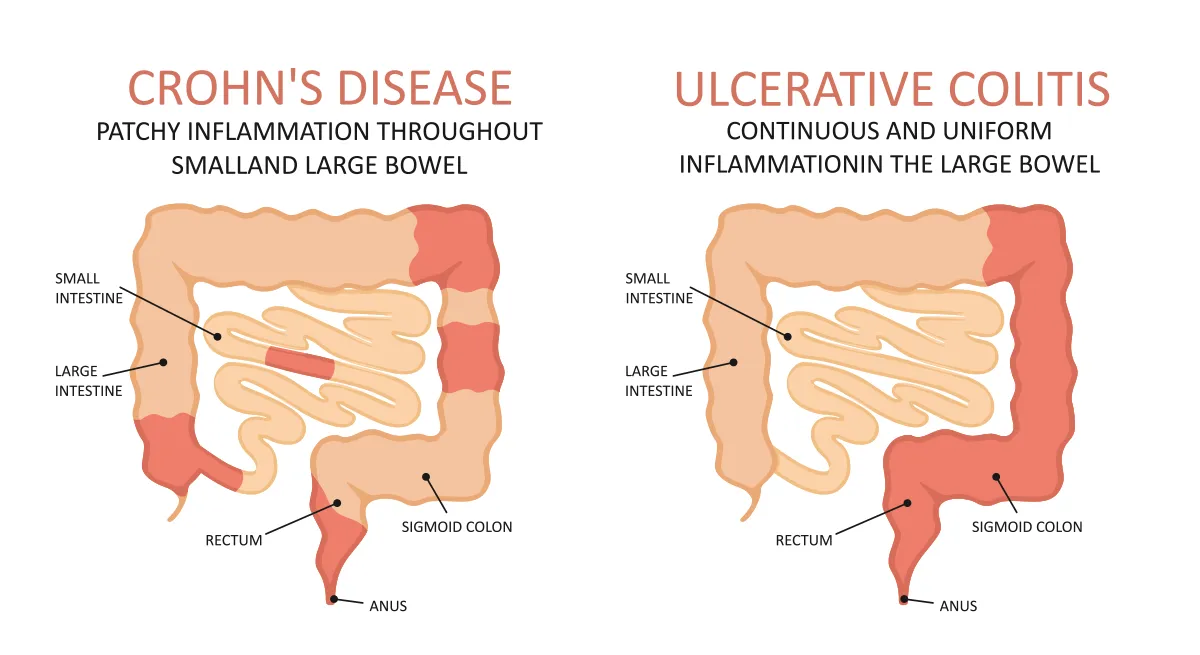 Inflammatory Bowel Disease diagram