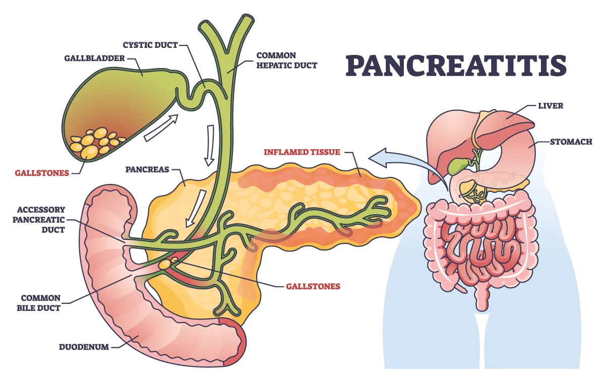 Pancreatitis diagram