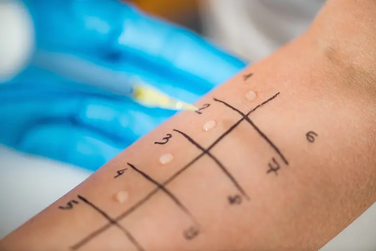 Skin Prick Allergy Test